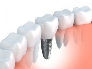 Dental Implants – Graphic Image